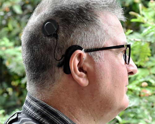 Cochlea-Implantat bei einem Mann._Hear hear!, CC BY-SA 4.0 A man with a cochlear implant._Hear hear!, CC BY-SA 4.0