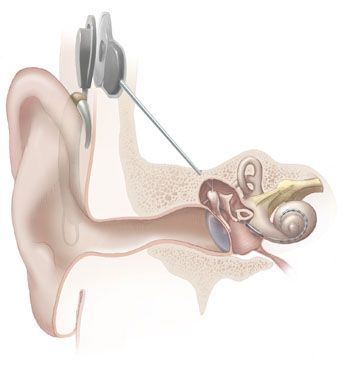 Cochlea-Implntat Cochlear Implant