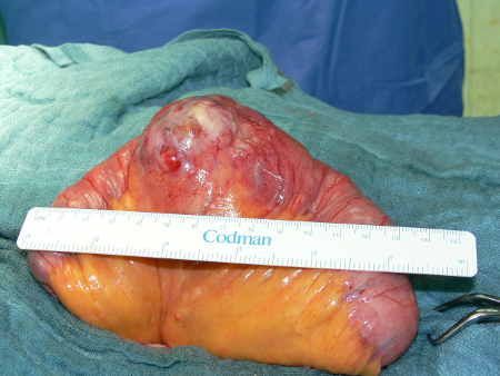 Darmresektion 2 Darmresektion 2