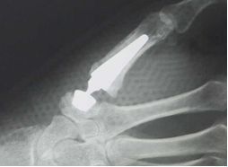 Daumensattelgelenksprothese Thumb Saddle Joint Prosthesis
