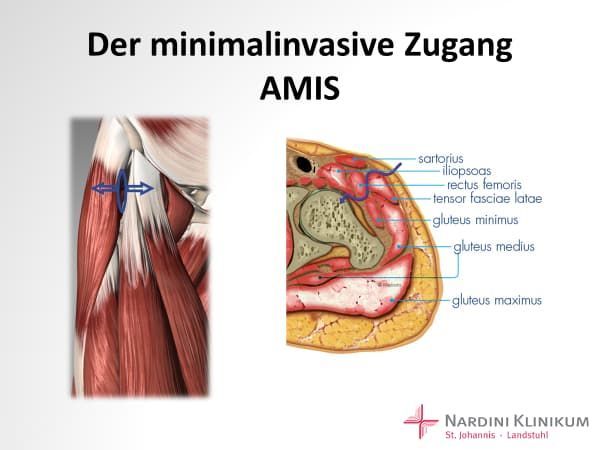 Foto Der minimalinvasive Zugang mit AMIS Foto Der minimalinvasive Zugang mit AMIS