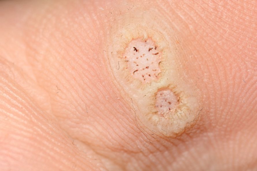 Plantar Wart on the Foot