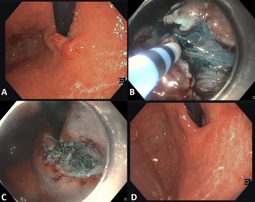 Ein Tumor am Mageneingang (A) wird im Rahmen einer Magenspiegelung mit einem millimetergroßen endoskopischen Messer von der Magenwand abpräpariert (B). Der verbleibende Wunddefekt (C) ist nach wenigen Wochen komplett abgeheilt (D). Ein Tumor am Mageneingang (A) wird im Rahmen einer Magenspiegelung mit einem millimetergroßen endoskopischen Messer von der Magenwand abpräpariert (B). Der verbleibende Wunddefekt (C) ist nach wenigen Wochen komplett abgeheilt (D).