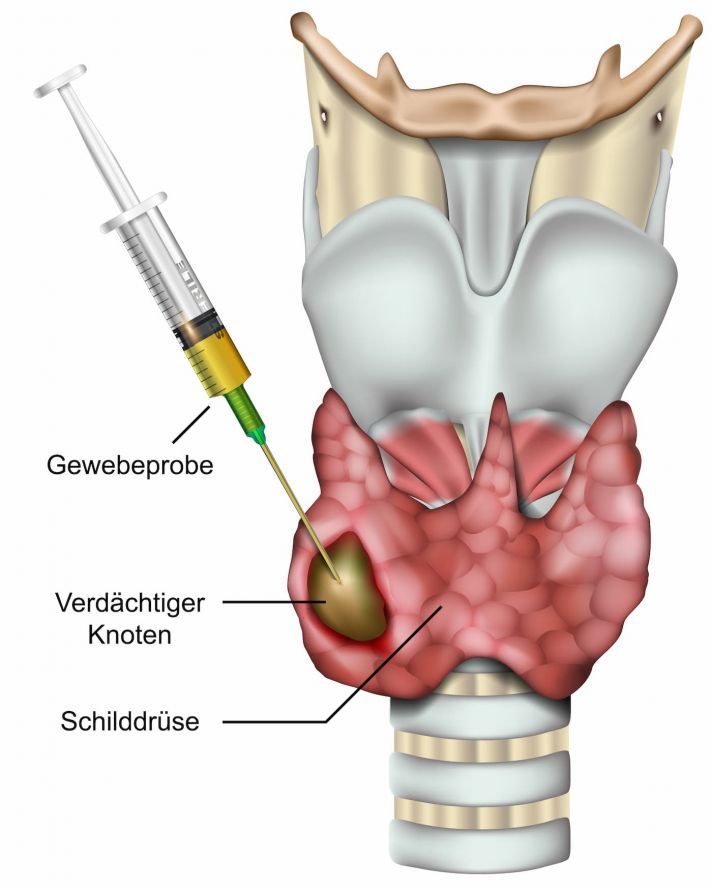 Feinnadelbiopsie der Schilddrüse Feinnadelbiopsie der Schilddrüse