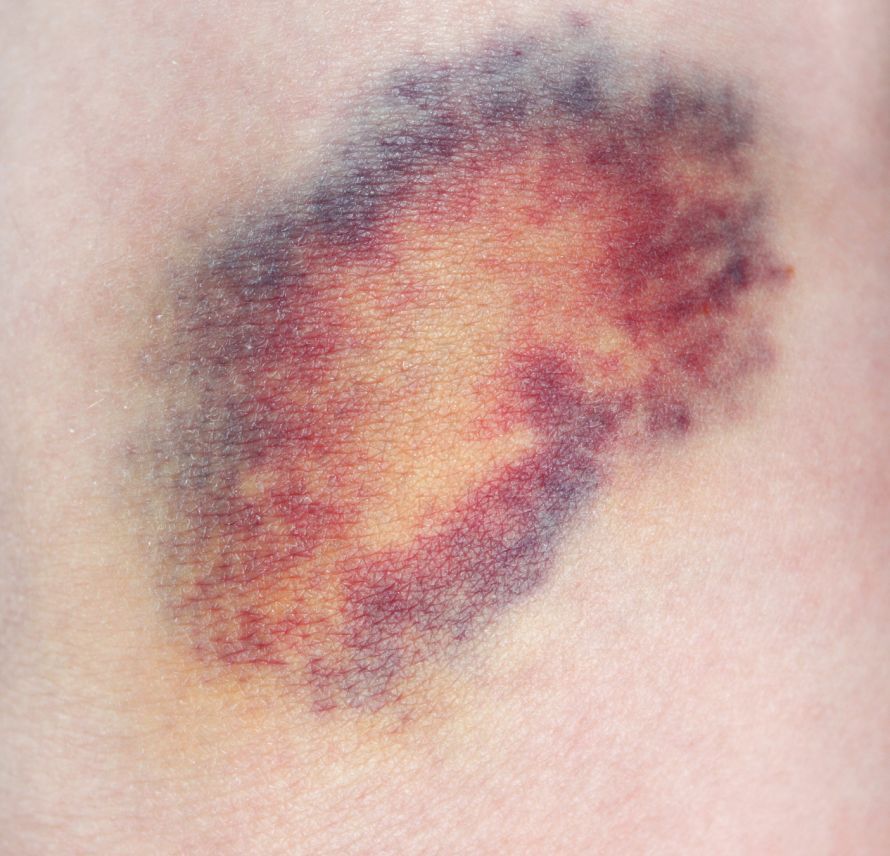 Bluterguss Hämatom Bruise, Hematoma
