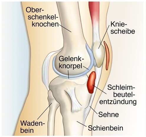 Schleimbeutelentzündung Knie Αρθρίτιδα του γόνατος