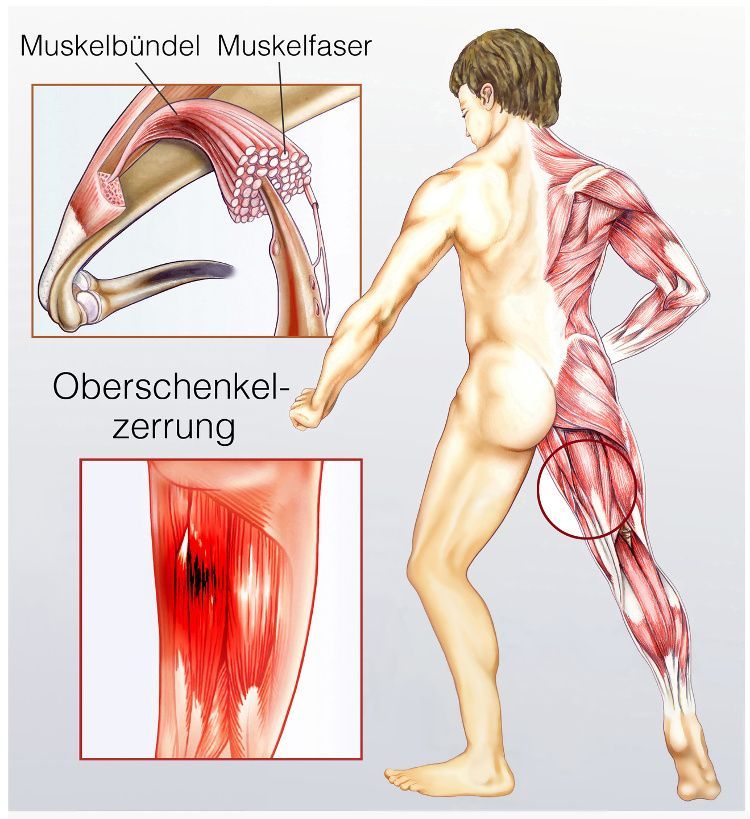 Muskelzerrung Oberschenkel Thigh Muscle Strain