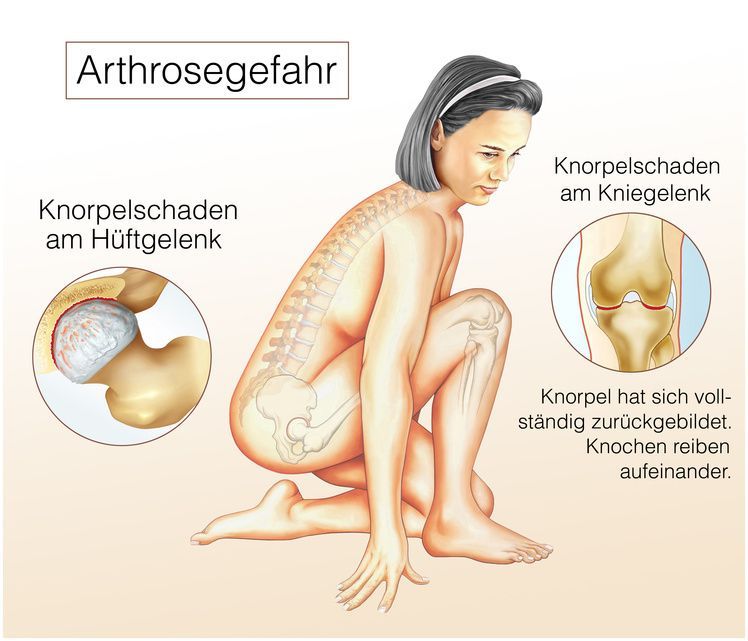Arthrose im Hüftgelenk und Kniegelenk Arthrose im Hüftgelenk und Kniegelenk