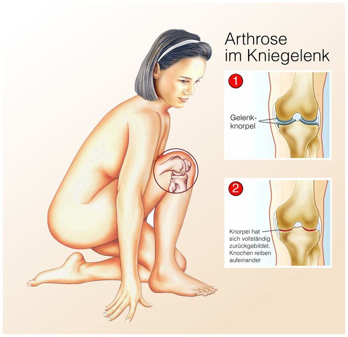 Kniearthrose Kniearthrose