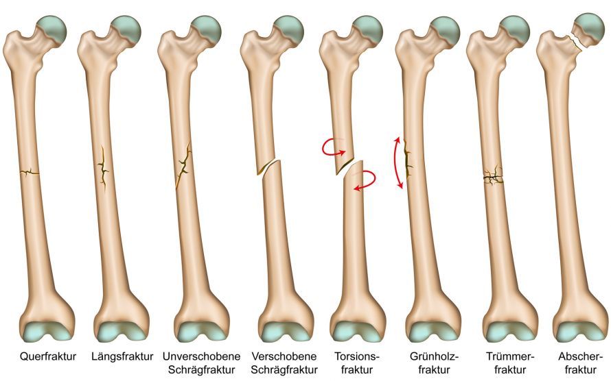 Knochenbruch - Frakturarten Bone Fractures - Types of Fractures
