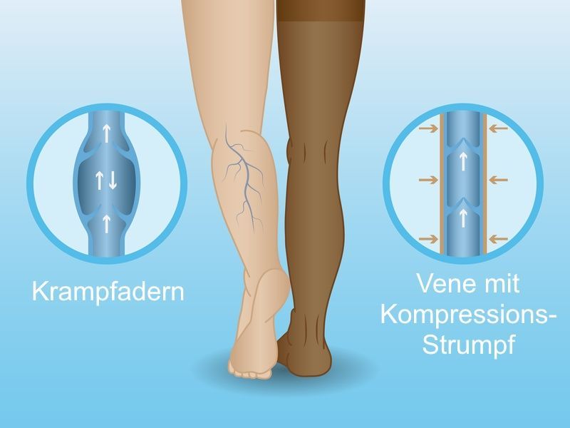 How Compression Stockings Work for Varicose Veins