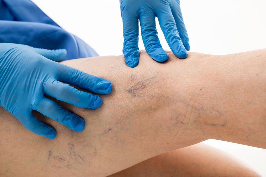 Besenreiser spider veins