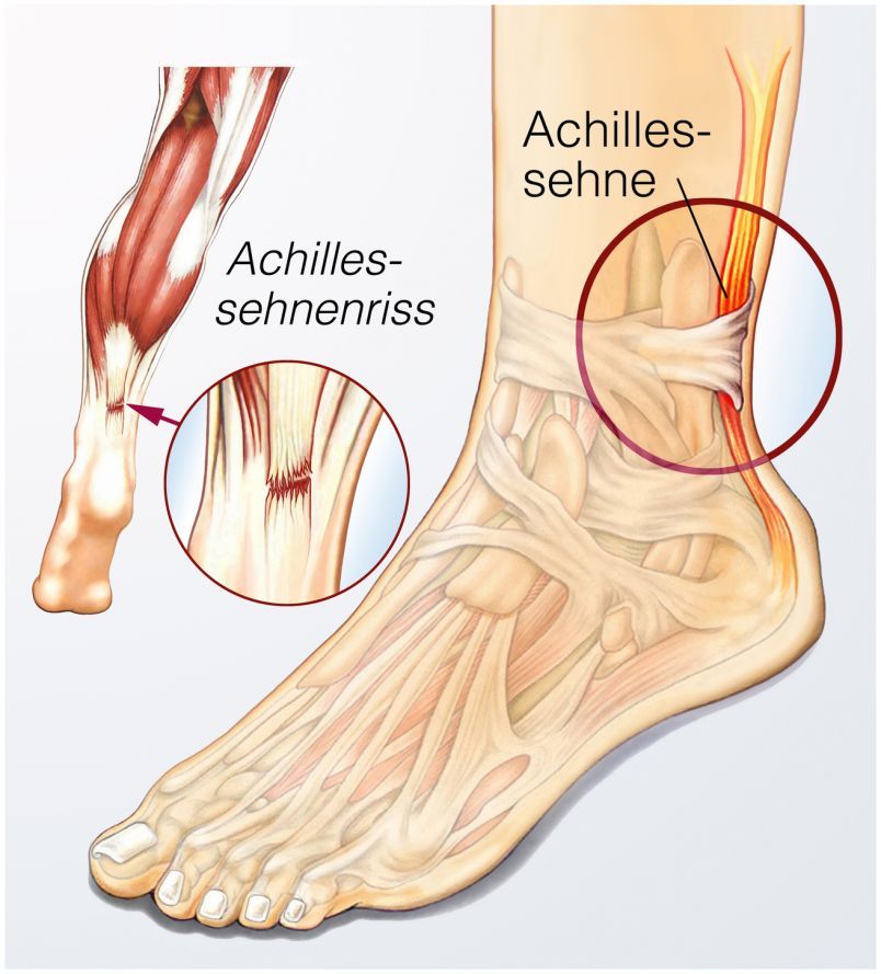 Achilles tendon rupture