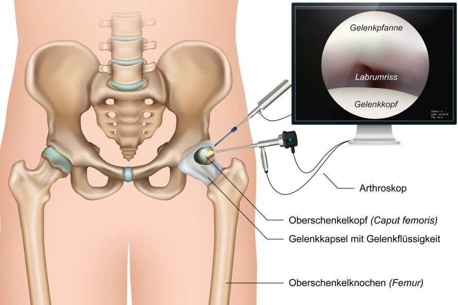 Hüftgelenk Arthroskopie Αρθροσκόπηση ισχίου