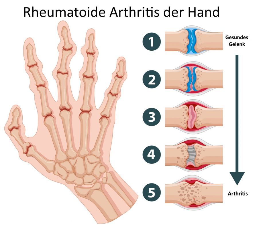 Rheumatoide Arthritis Hand Rheumatoid Arthritis of the Hand