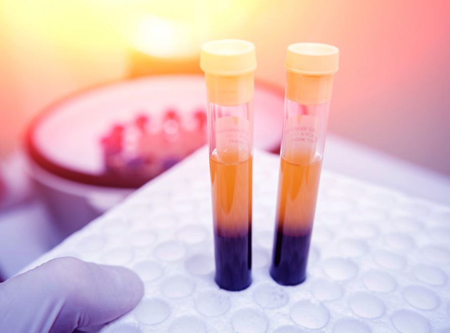Blutplasma in Reagenzgläsern Blood plasma in test tubes