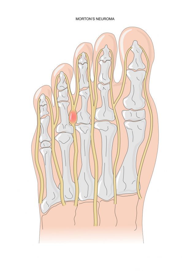 Morton's Neuroma