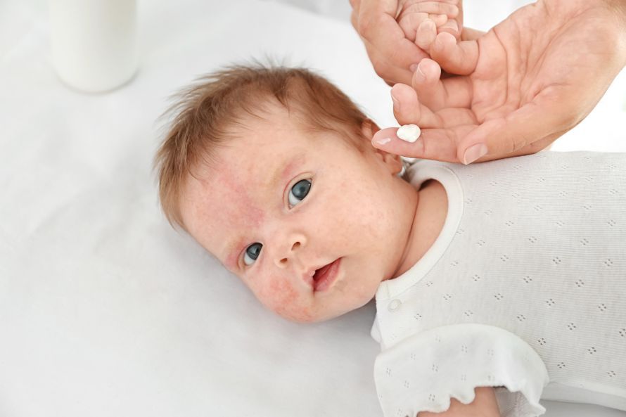 Baby mit Neurodermitis Baby mit Neurodermitis