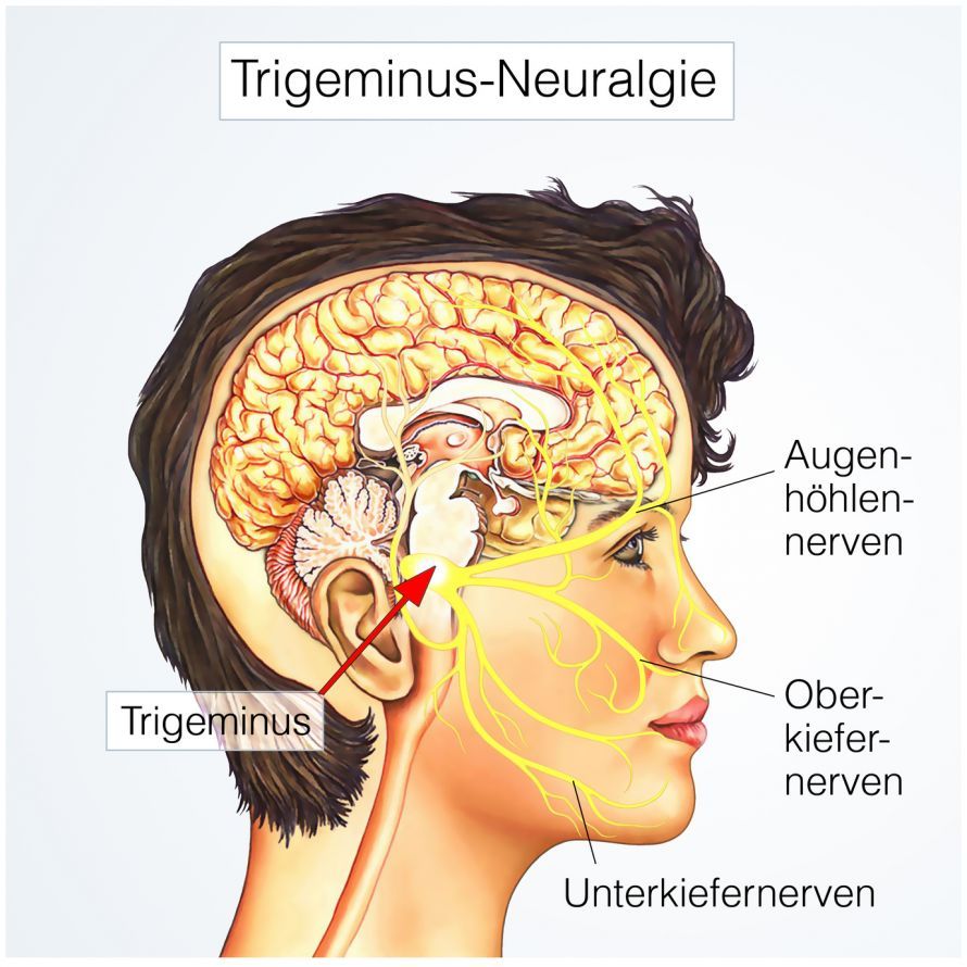 Trigeminal Neuralgia