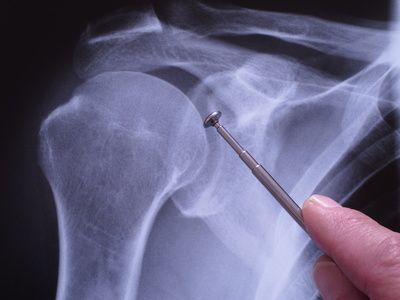 Schulterchirurgie