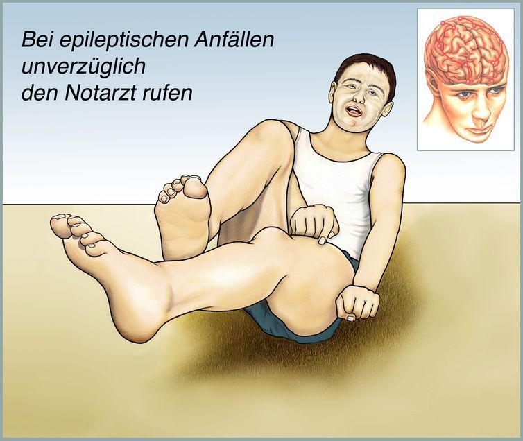 epileptischer Anfall