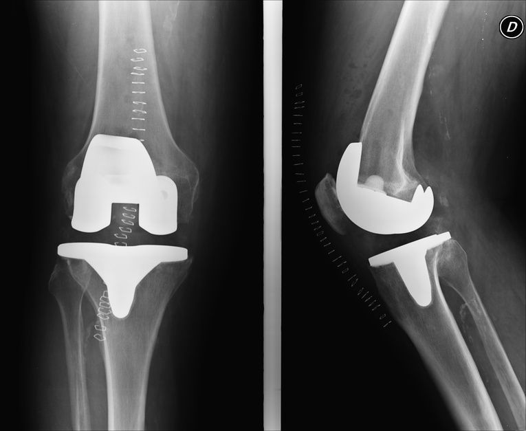 Knie-TEP im Röntgenbild Knie-TEP im Röntgenbild