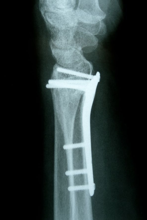 Handgelenksfraktur mit Plattenfixierung und Schrauben Wrist fracture treated with plate fixation and screws