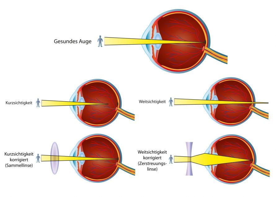 Fehlsichtigkeiten der Augen Fehlsichtigkeiten der Augen