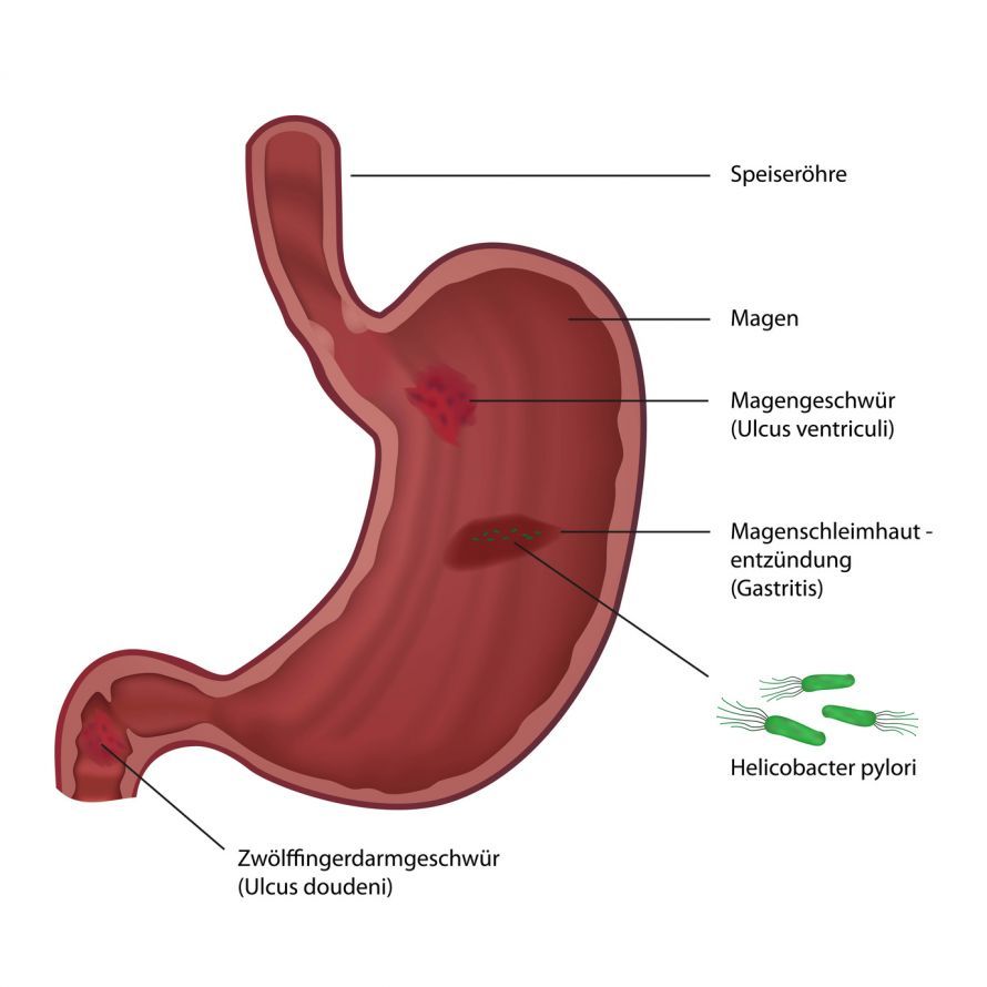 Infektion des Magens mit Helicobacter Pylori Λοίμωξη του στομάχου από το Helicobacter pylori