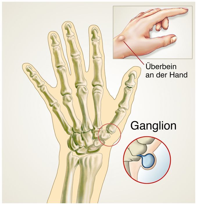 Ganglion on the hand