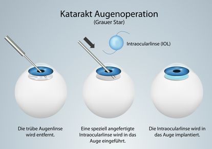 Katarakt-OP Χειρουργική επέμβαση καταρράκτη