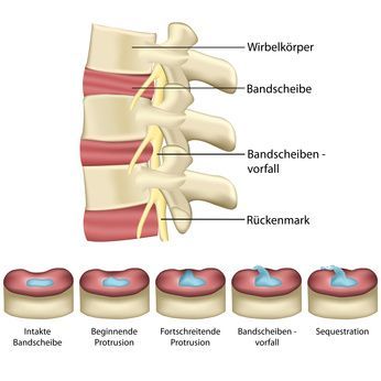 Bandscheibenschäden Bandscheibenschäden
