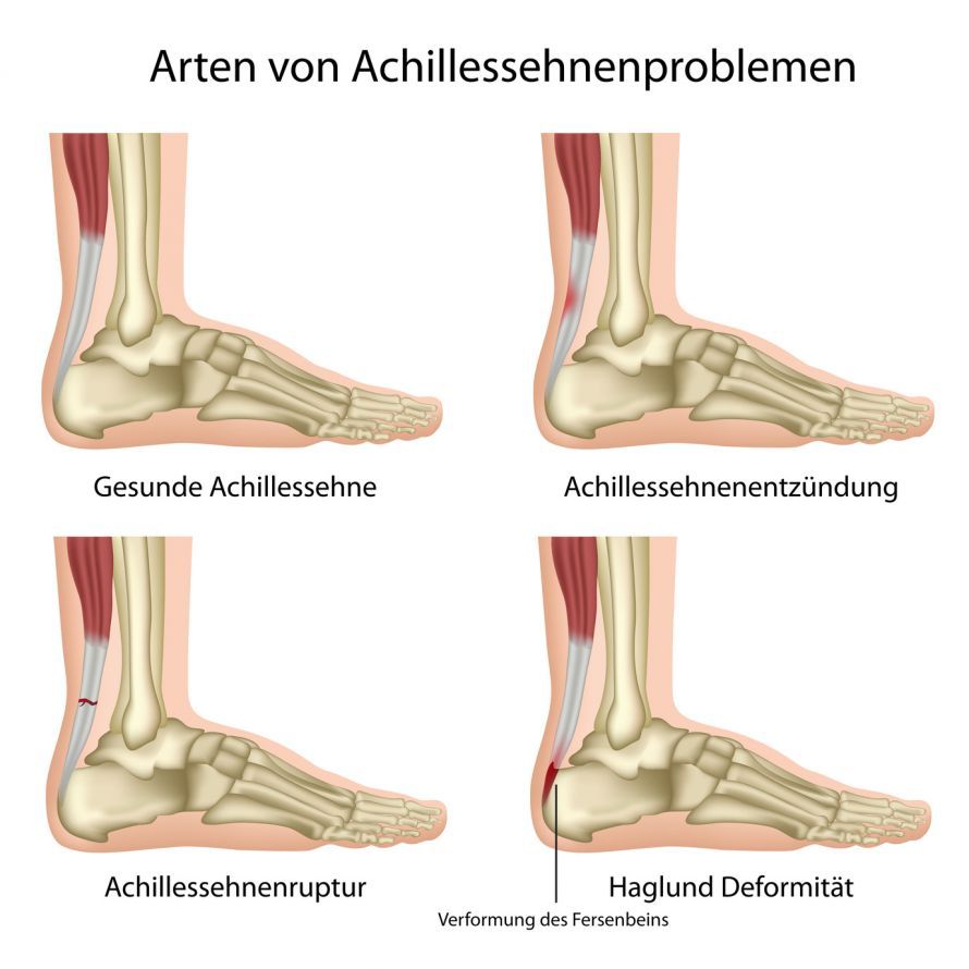 Achillessehnenverletzungen und Haglundferse Achillessehnenverletzungen und Haglundferse