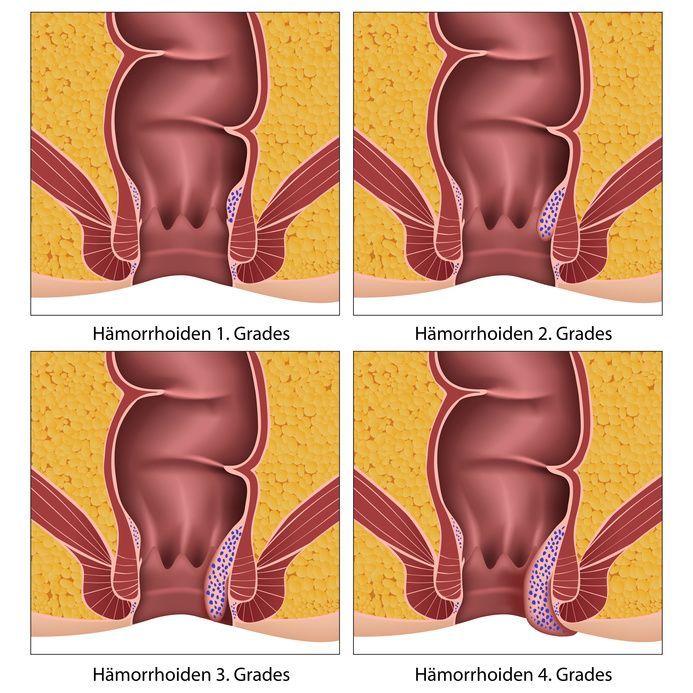 Hämorrhoiden Αιμορροΐδες