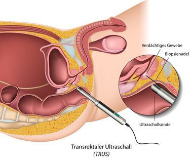 Prostata Diagnose mit TRUS Prostata Diagnose mit TRUS