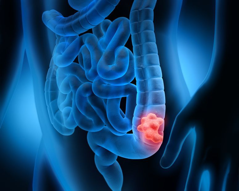 Darmverschluss Intestinal Obstruction