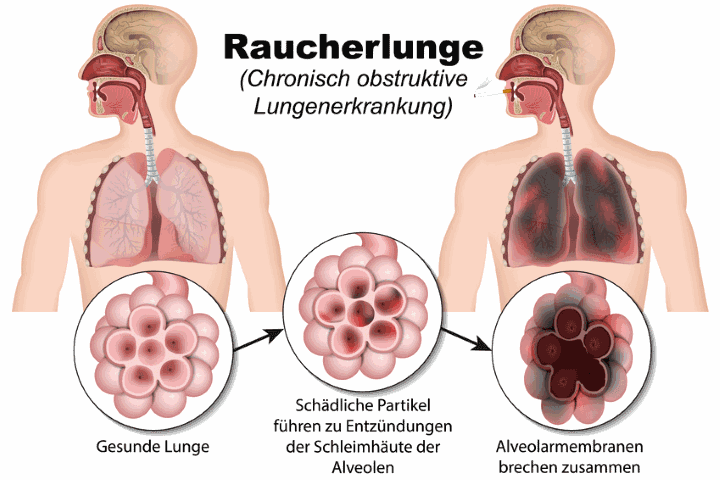 Raucherlunge (COPD) Raucherlunge (COPD)