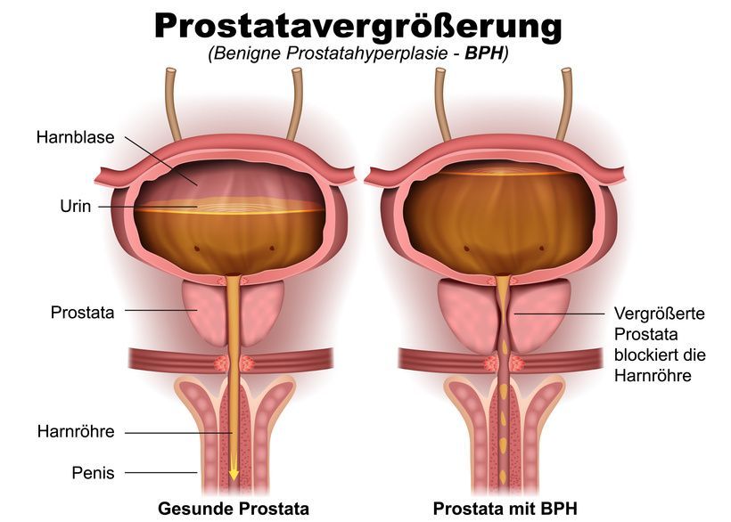 Prostatavergrößerung Prostatavergrößerung