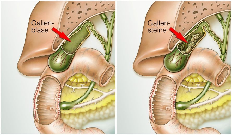 Technique à port unique en chirurgie de la vésicule biliaire