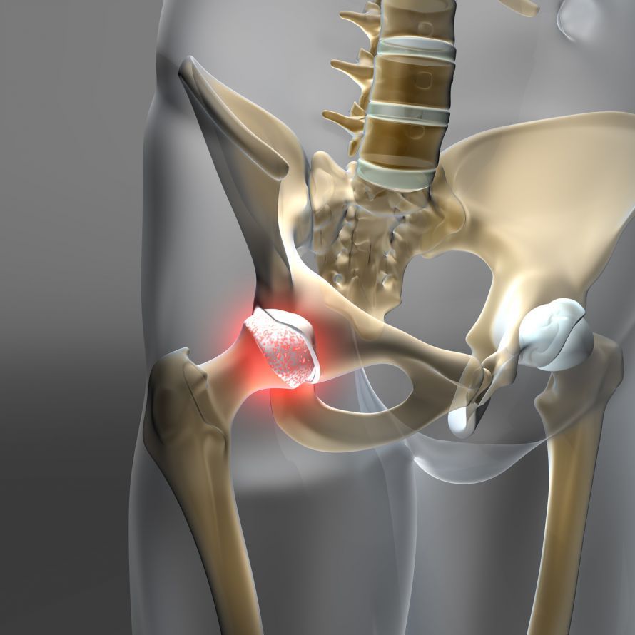 Arthrose Hüftgelenk - Koxarthrose Arthrose Hüftgelenk - Koxarthrose
