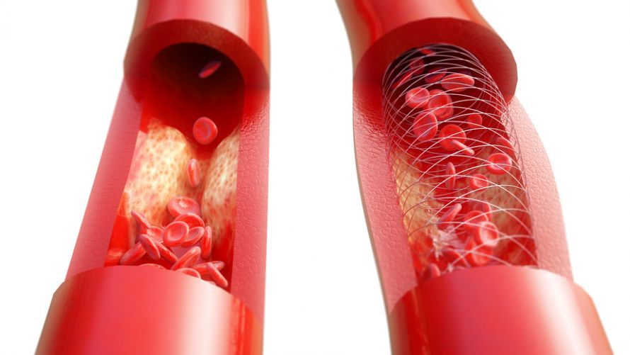 Gefäßbehandlung mit Stent Αγγειακή θεραπεία με στεντ