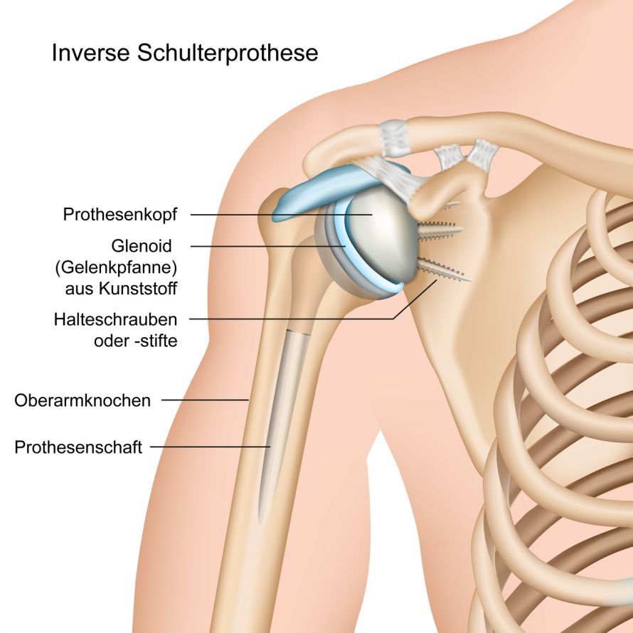 Inverse Schulterprothese Inverse Schulterprothese