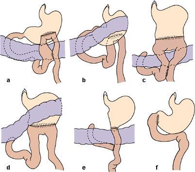 Gastroenterostomie Gastroenterostomie