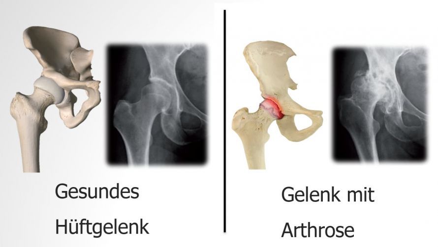 Foto Gesundes Hüftgelenk mit Arthrose Foto Gesundes Hüftgelenk mit Arthrose