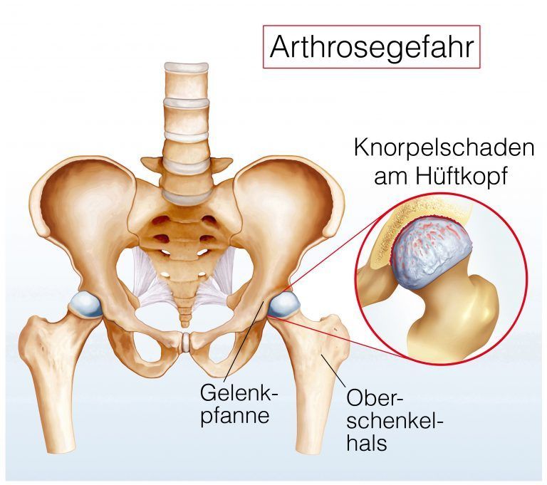 Hüftarthrose Hüftarthrose