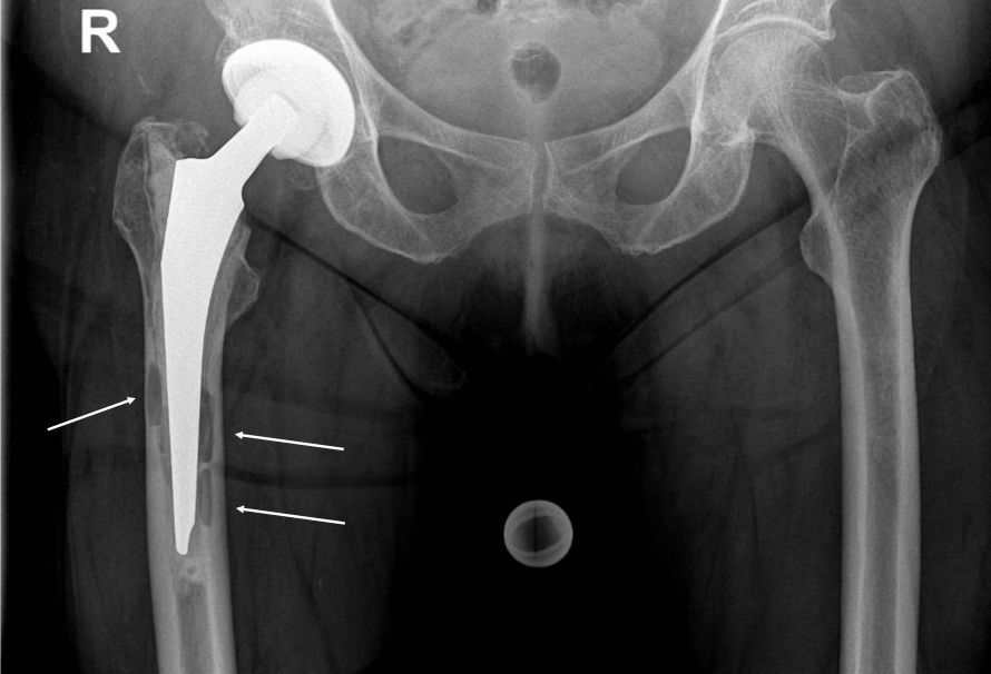 Partially cemented right hip prosthesis with multiple areas of osteolysis (“arrows”) in the stem region, indicating an existing infection.