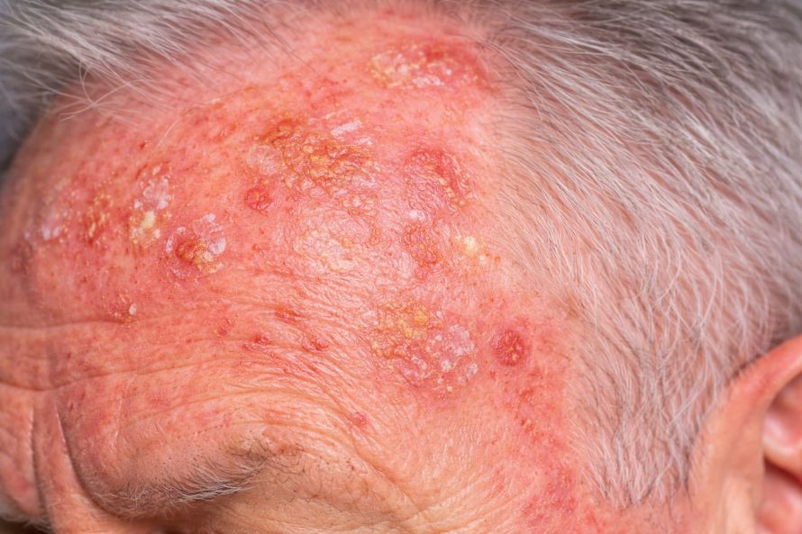 Hautveränderungen durch Sonnenexposition Skin Changes Caused by Sun Exposure