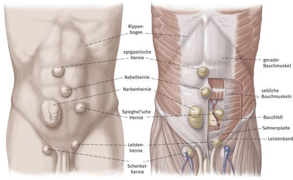 Hernienarten Hernienarten