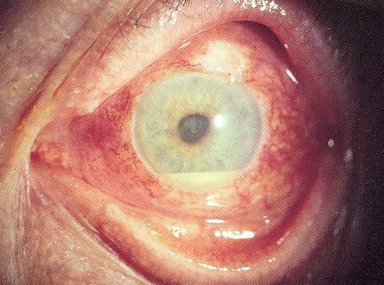 Hypopyon – leukozytäres Exsudat in der vorderen Augenkammer. Hypopyon – leukozytäres Exsudat in der vorderen Augenkammer.