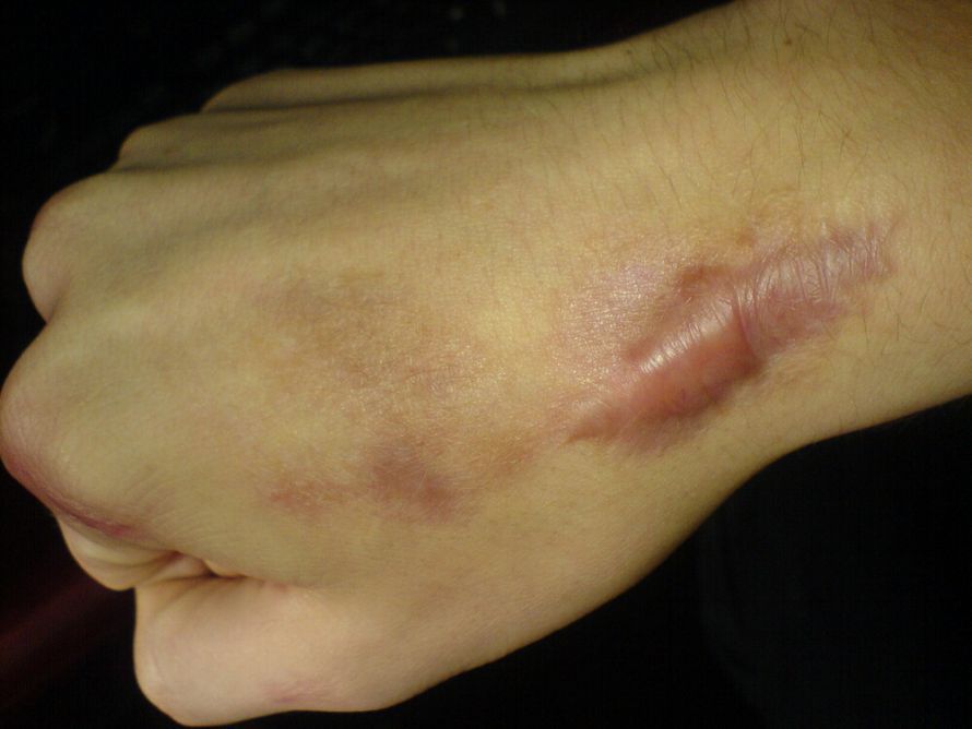 Keloid aus einer Operationswunde
